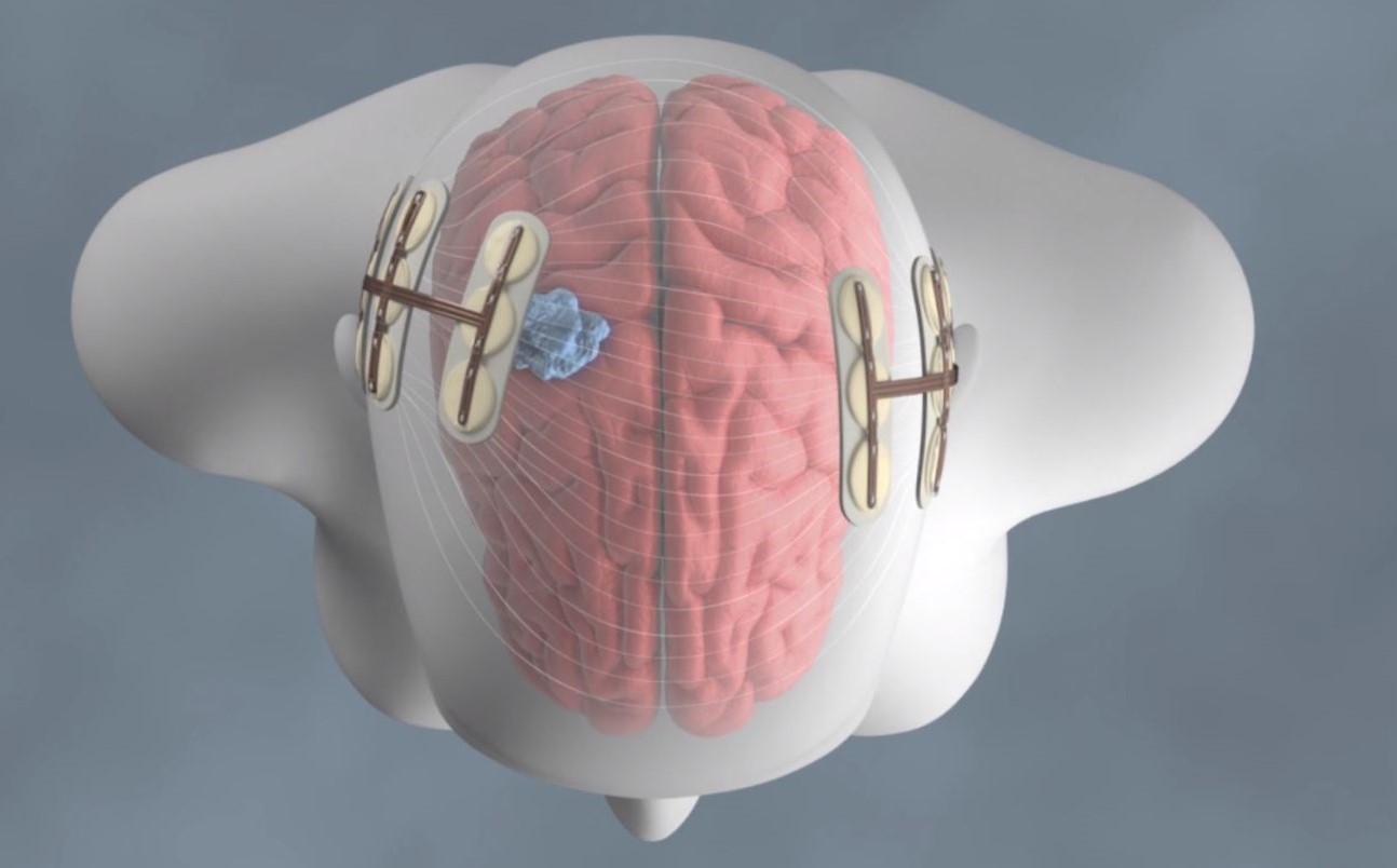 Wie bekomme ich Optune? Wer übernimmt die Kosten von Optune?